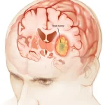 mcdc7_brain_cancer-8col
