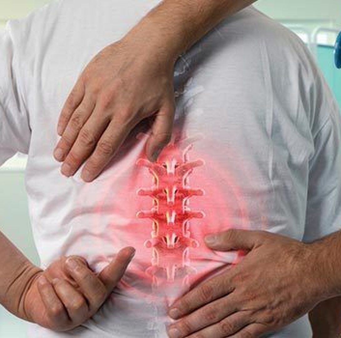 radiculopathy